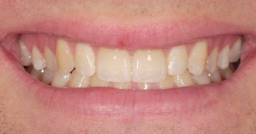 after teeth whitening