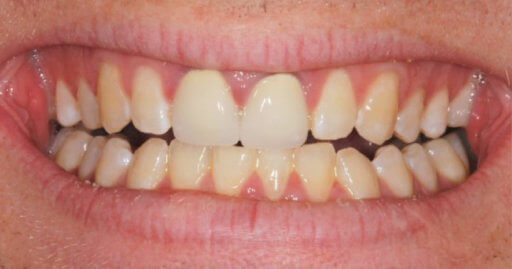 before teeth whitening