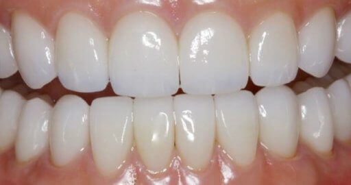 after teeth straightening