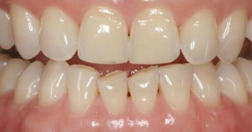 before teeth straightening