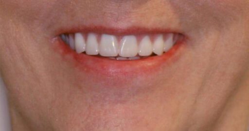 after dental braces
