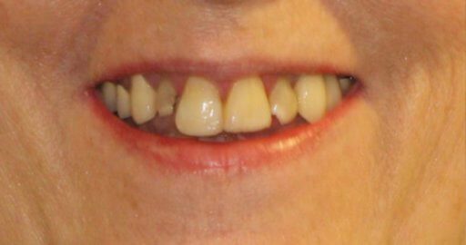 before dental braces