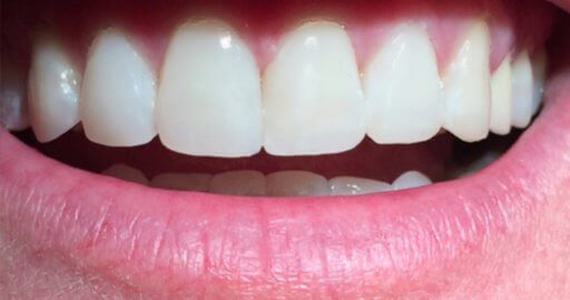 after chipped tooth repair