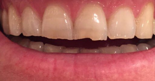 before and after chipped teeth